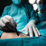 Close up of a plastic surgeon marking the human skin for surgery.