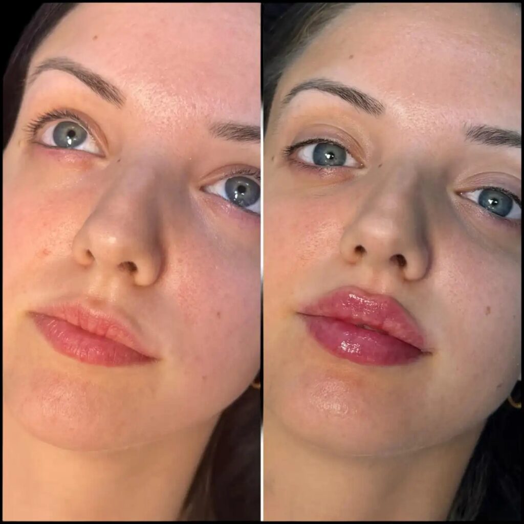 fillers