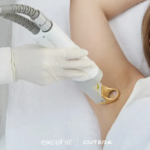 Laser Hair Removal