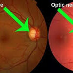 stem cell treatment for optic nerve atrophy in germany