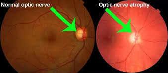 stem cell treatment for optic nerve atrophy in germany