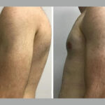 gynecomastia in Dubai
