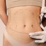 vaser liposuction in dubai