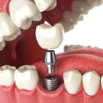 Dental-Implant-in-Dubai