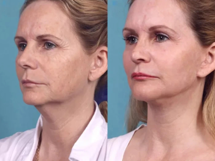 Chemical Peel Treatment in Dubai