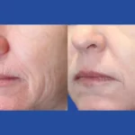 fractional-rf-microneedling in dubai