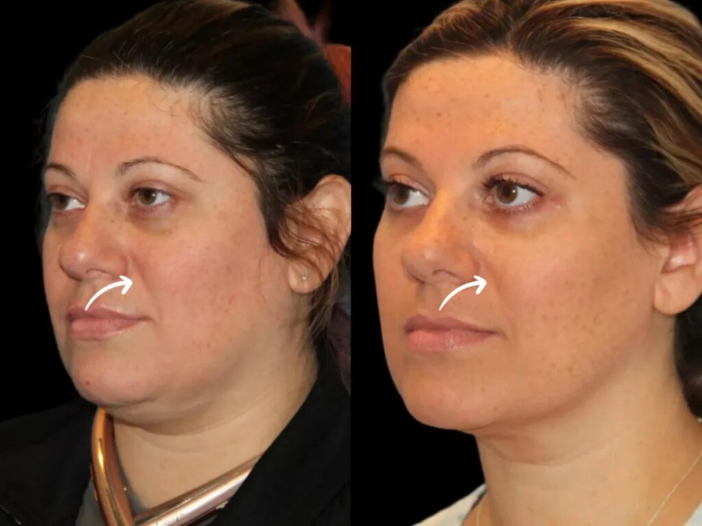 sculptra in dubai
