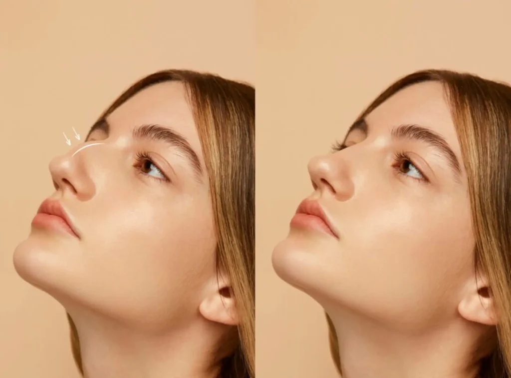 Non-Invasive-Rhinoplasty