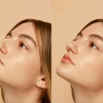 Non-Invasive-Rhinoplasty