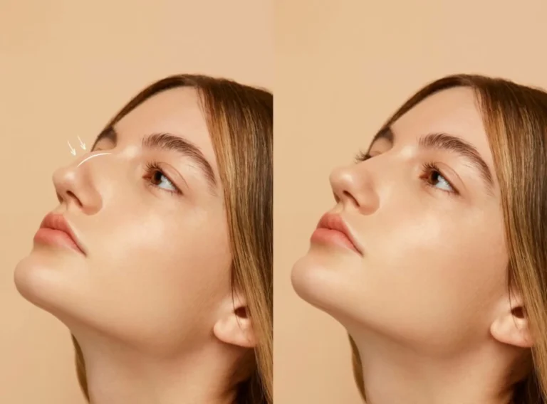 Non-Invasive-Rhinoplasty