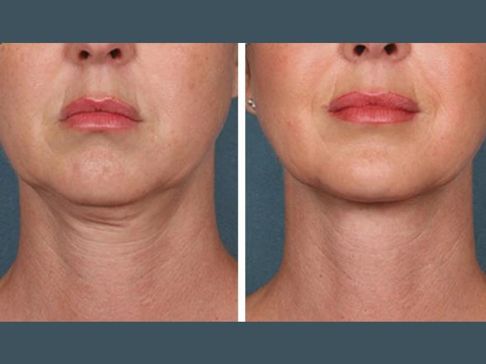 PRP Treatment in Dubai