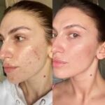 Skinpen microneedling in Altrincham