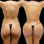 Butt Fat Transfer in Dubai 