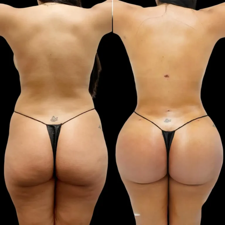 Butt Fat Transfer in Dubai 