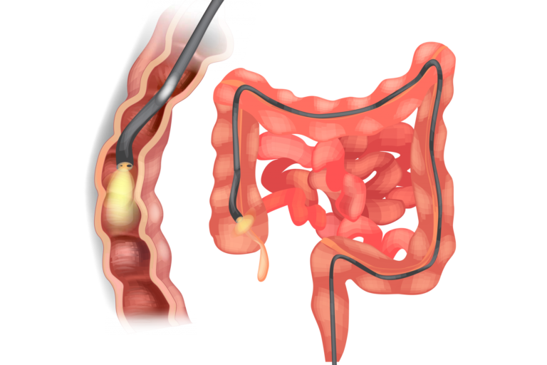 colonoscopy (1)