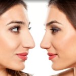 rhinoplsty