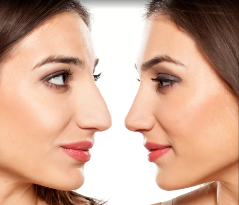 rhinoplsty