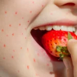 strawberry-allergy.jpg (1)