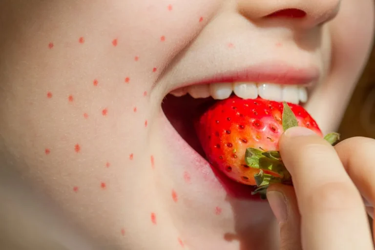 strawberry-allergy.jpg (1)
