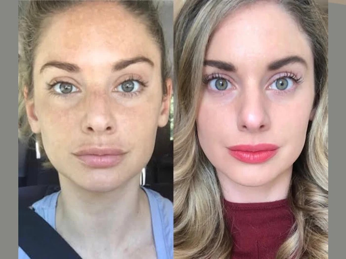 RF-Microneedling IN DUBAI