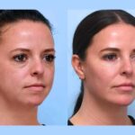 Thread lift Treatments in Dubai for Comprehensive Facial Rejuvenation Strategies Today