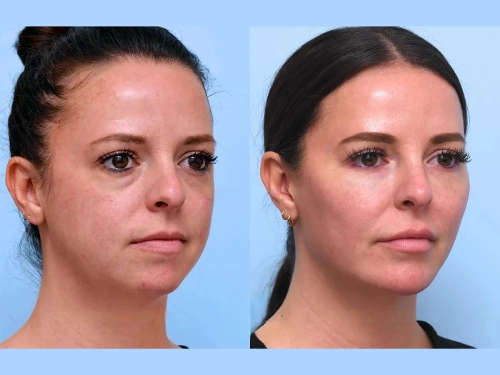 Thread lift Treatments in Dubai for Comprehensive Facial Rejuvenation Strategies Today