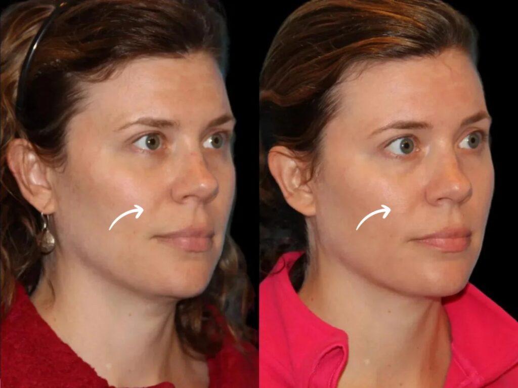 SCULP[TRA FILLERS IN DUBAI