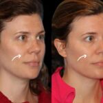 SCULP[TRA FILLERS IN DUBAI
