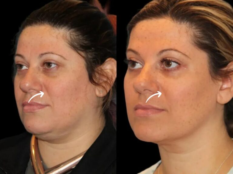 sculptra fillers in dubai
