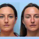 Thread Lift by Best Plastic Surgeons in Dubai for Defined Contours