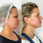 Best Doctors in dubai Redefining Beauty with Endolift Innovations
