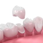 dental crown dubai