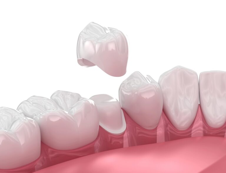 dental crown dubai