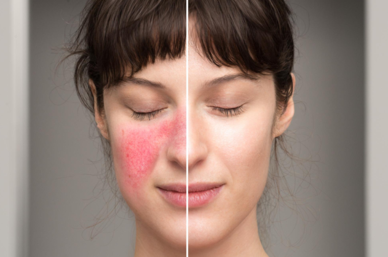 Rosacea in Manchester