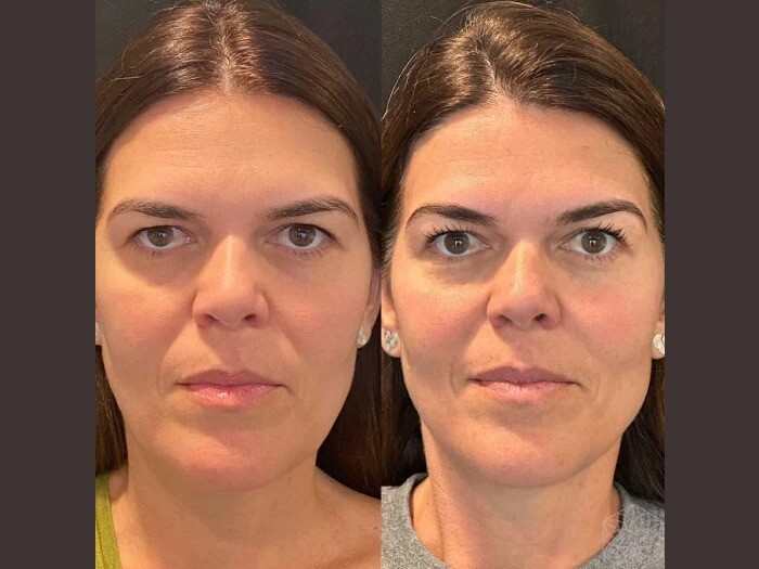 Thread Lift by Best Plastic Surgeons in Dubai for Facial Rejuvenation