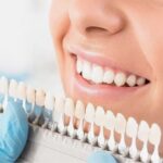 veneer