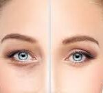 Chirurgie des paupières inférieures à Paris