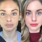 Radiofrequency (RF) Microneedling in Dubai