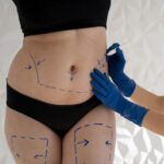 Tummy Tuck in Riyadh