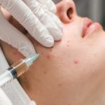 acne treatment