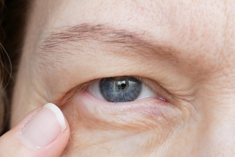 eyelid surgery in dubai