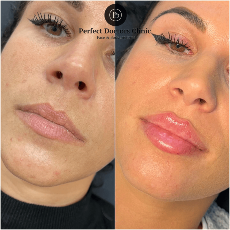 Juvederm in Dubai