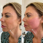 The Growing Popularity of Endolift in Dubai Among Professionals
