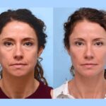 Best Plastic Surgeon in Dubai Offering Safe And Effective Thread Lift
