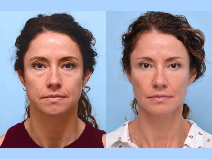 Best Plastic Surgeon in Dubai Offering Safe And Effective Thread Lift