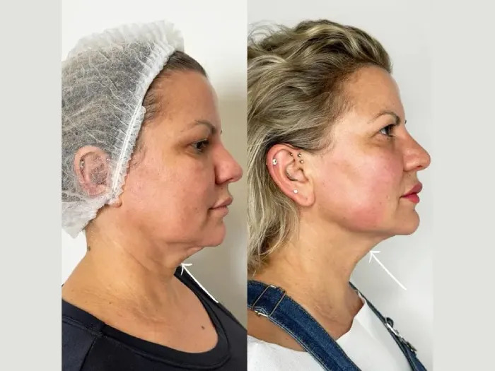 Why Endolift Treatment in Dubai Is Trending Among Beauty Enthusiasts