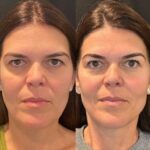 Best Doctors in Dubai Performing Premium Quality Thread Lift
