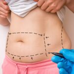 Monsplasty In Dubai – Enhance Your Silhouette with Confidence