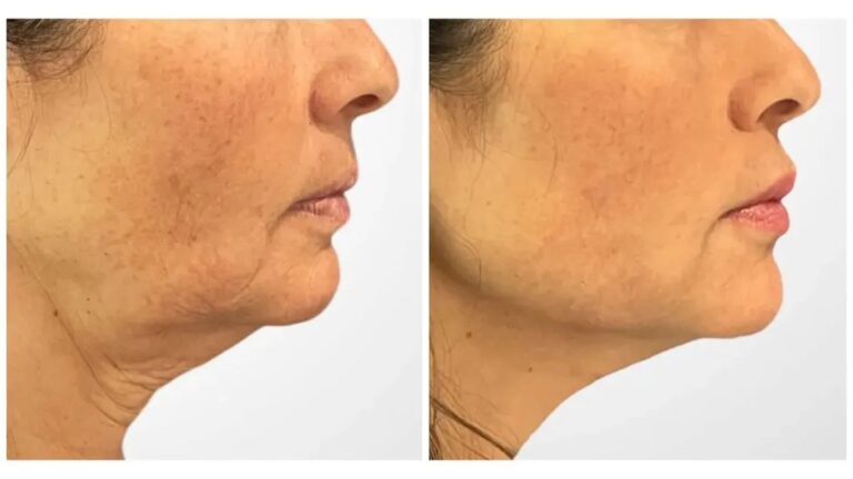 Thread lift by Best Doctors in Dubai for Sculpted Facial Features