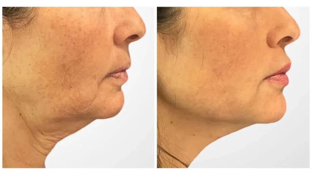 Best Plastic Surgeons in Dubai for Modern Anti Aging Thread Lift Treatment